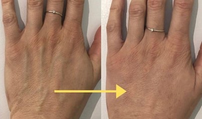 Hand rejuvenation treatment results | Cityskin